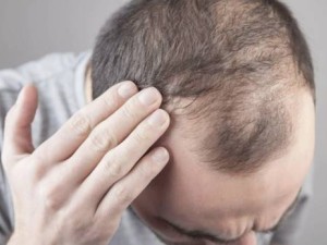 UCLA新突破：外用分子PP405让头发快速再生不再是梦